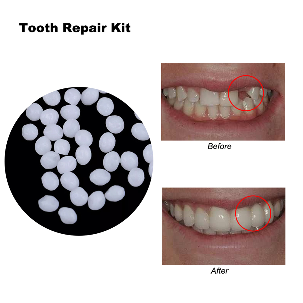 Teeth Whitening Diy - 10/100g DIY義歯歯茎接着剤 手作りソリッドキャビティプラッギンググルー 一時的な歯の穴修復材 実用的な歯のホワイトニング