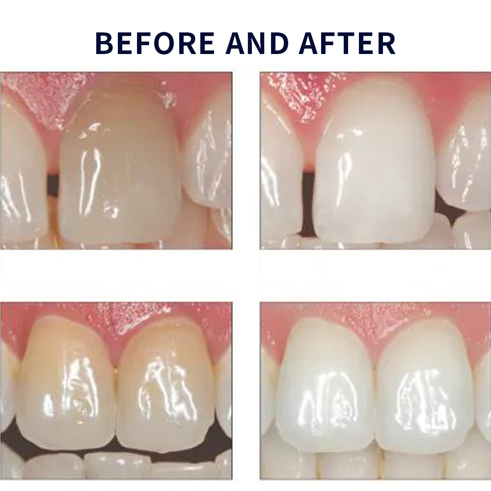 家庭用UV患者セット,プロの衛生機器,紫外線,16%,歯科材 - Teeth Whitening At Home Kit のレビューと価格