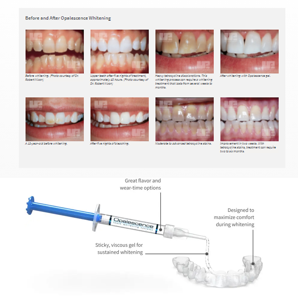 家庭用UV患者セット,プロの衛生機器,紫外線,16%,歯科材 - Teeth Whitening At Home Kit のレビューと価格