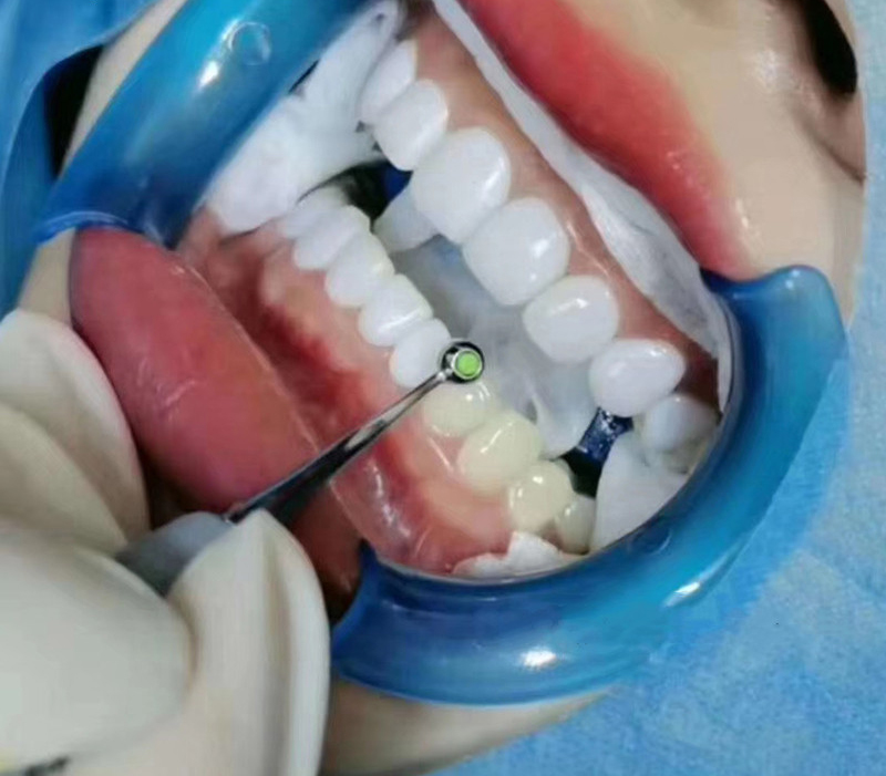 歯科用樹脂充填スパチュラ歯科用成形パッド前後複合樹脂ツールフ - Teeth Whitening Foam Toothpaste のレビューと価格