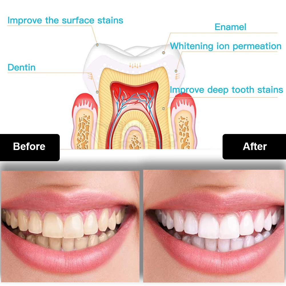歯科歯ホワイトニングキットミニ 16 LED コールドライト - Teeth Whitening Near Me のレビューと価格
