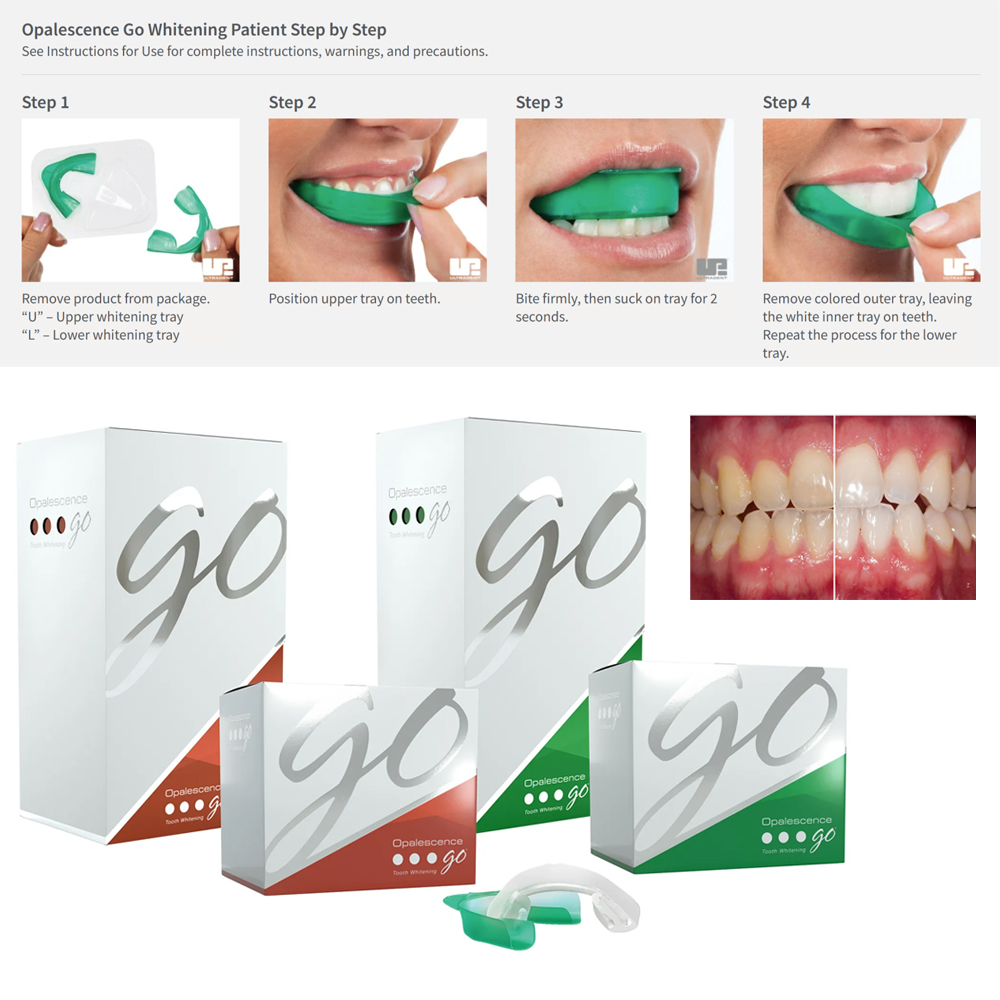Opalent go歯のホワイトトレイ、お家に詰められた患者 - Teeth Whitening At Home Kit のレビューと価格